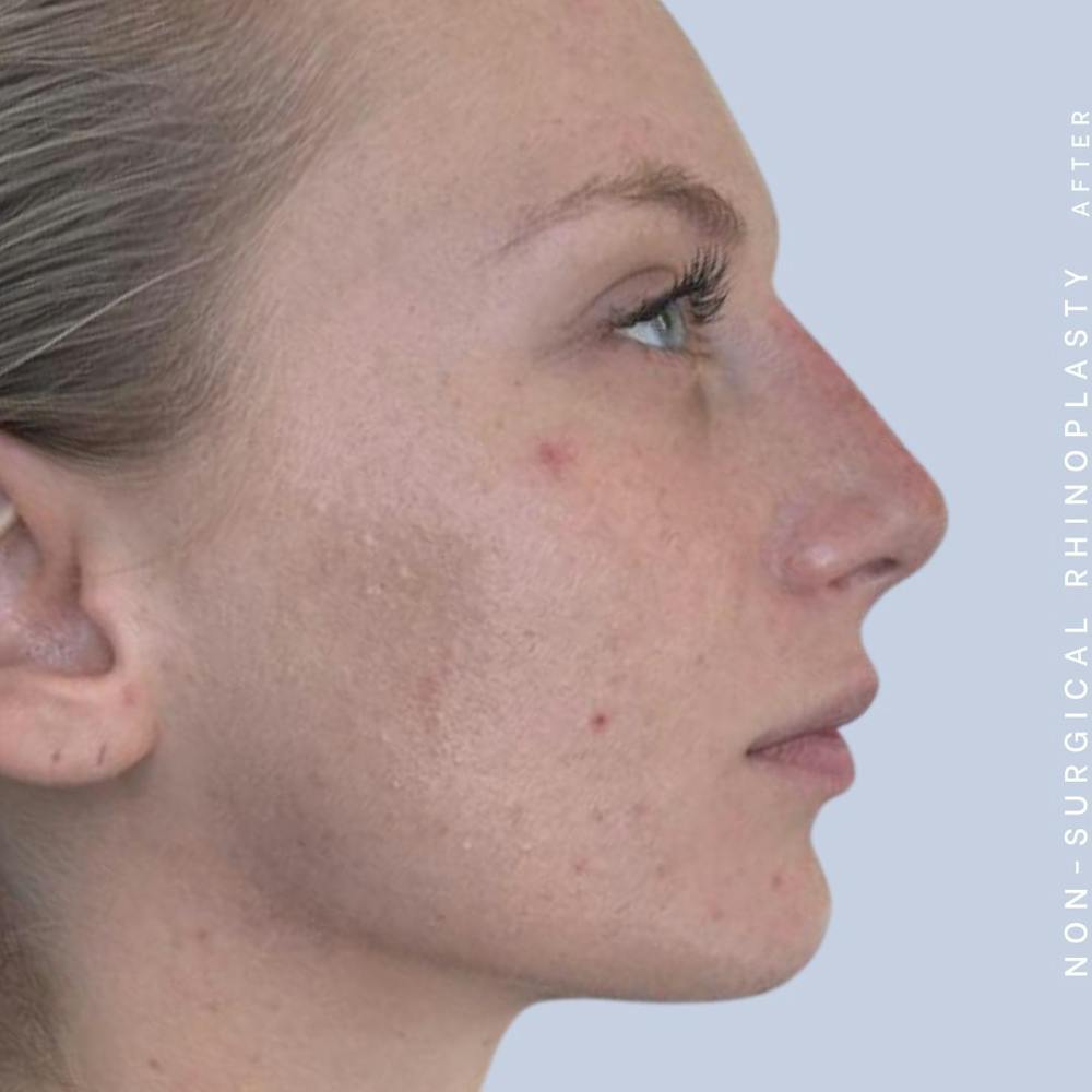 Non-Surgical Nose Before & After Gallery - Patient 142025234 - Image 6