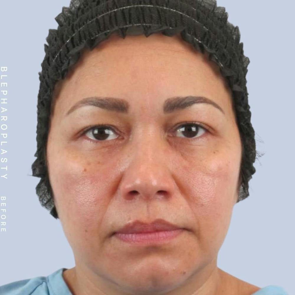 Eyes Before & After Gallery - Patient 117981740 - Image 1