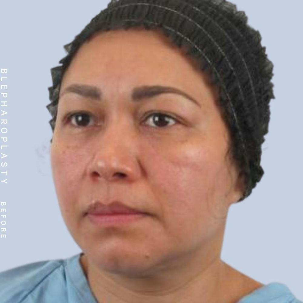 Eyes Before & After Gallery - Patient 117981740 - Image 3