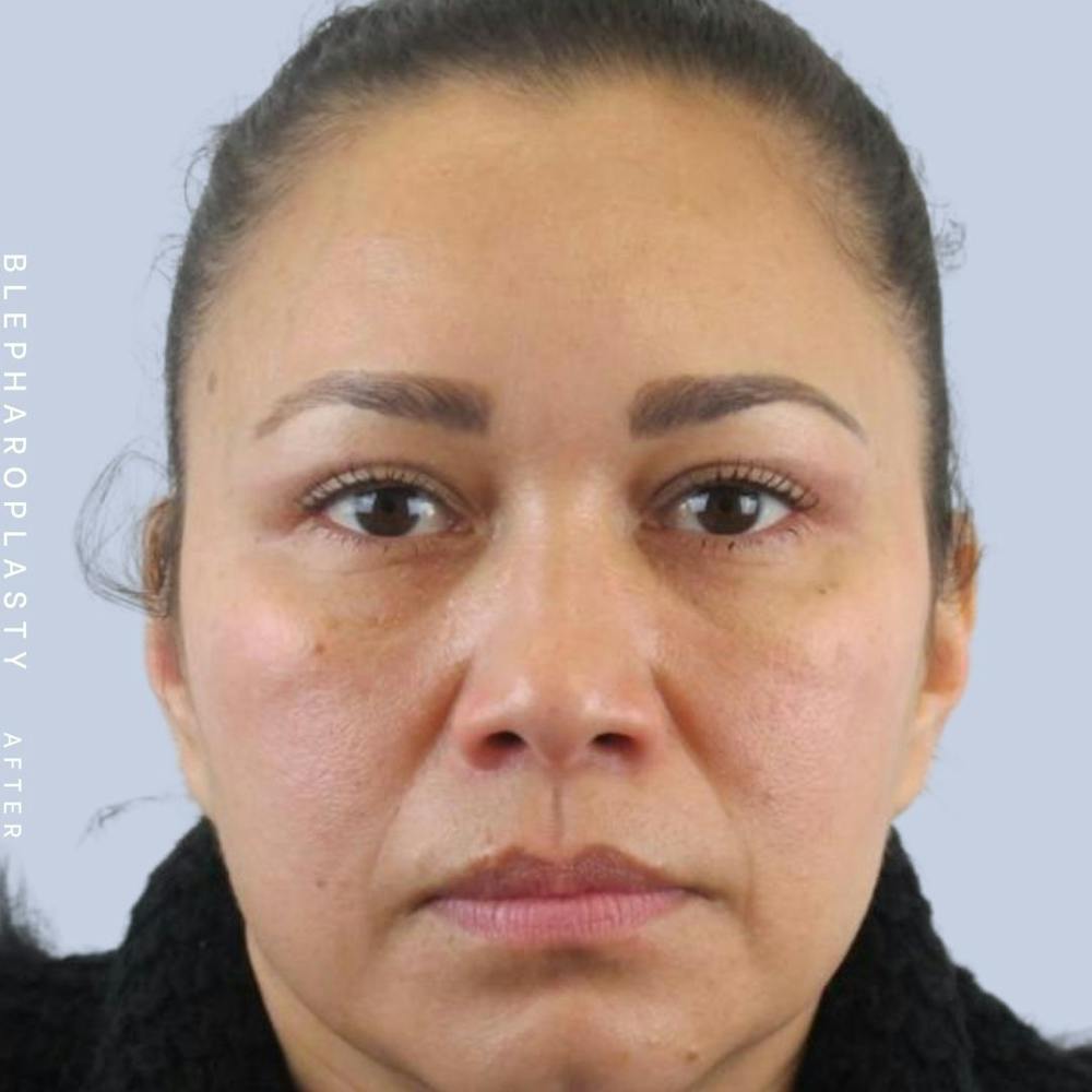 Eyes Before & After Gallery - Patient 117981740 - Image 2