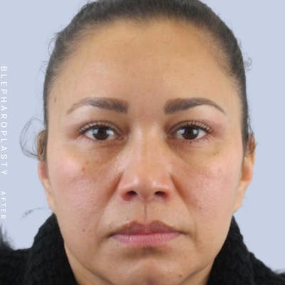 Eyes Before & After Gallery - Patient 117981740 - Image 2
