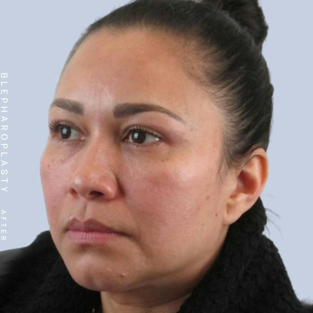 Eyes Before & After Gallery - Patient 117981740 - Image 4