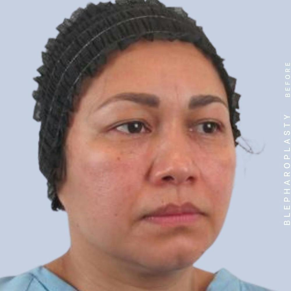 Eyes Before & After Gallery - Patient 117981740 - Image 5