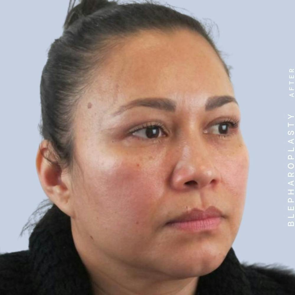 Eyes Before & After Gallery - Patient 117981740 - Image 6