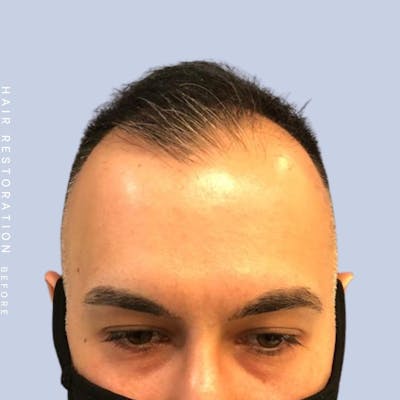 Hair Restoration Before & After Gallery - Patient 142787185 - Image 1