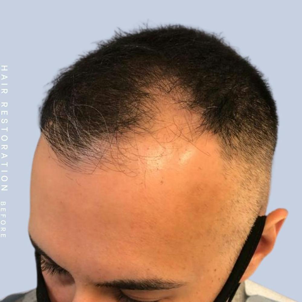 Hair Restoration Before & After Gallery - Patient 142787185 - Image 3