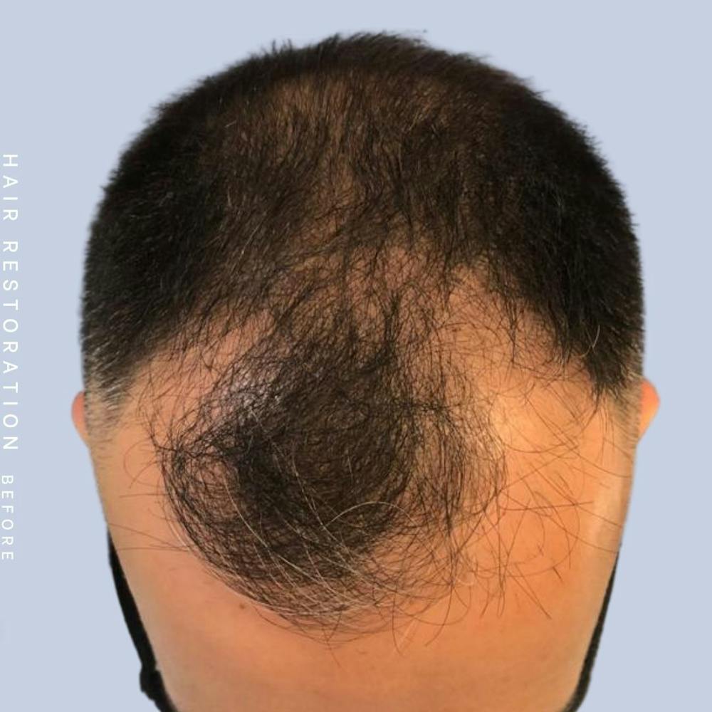 Hair Restoration Before & After Gallery - Patient 142787185 - Image 7