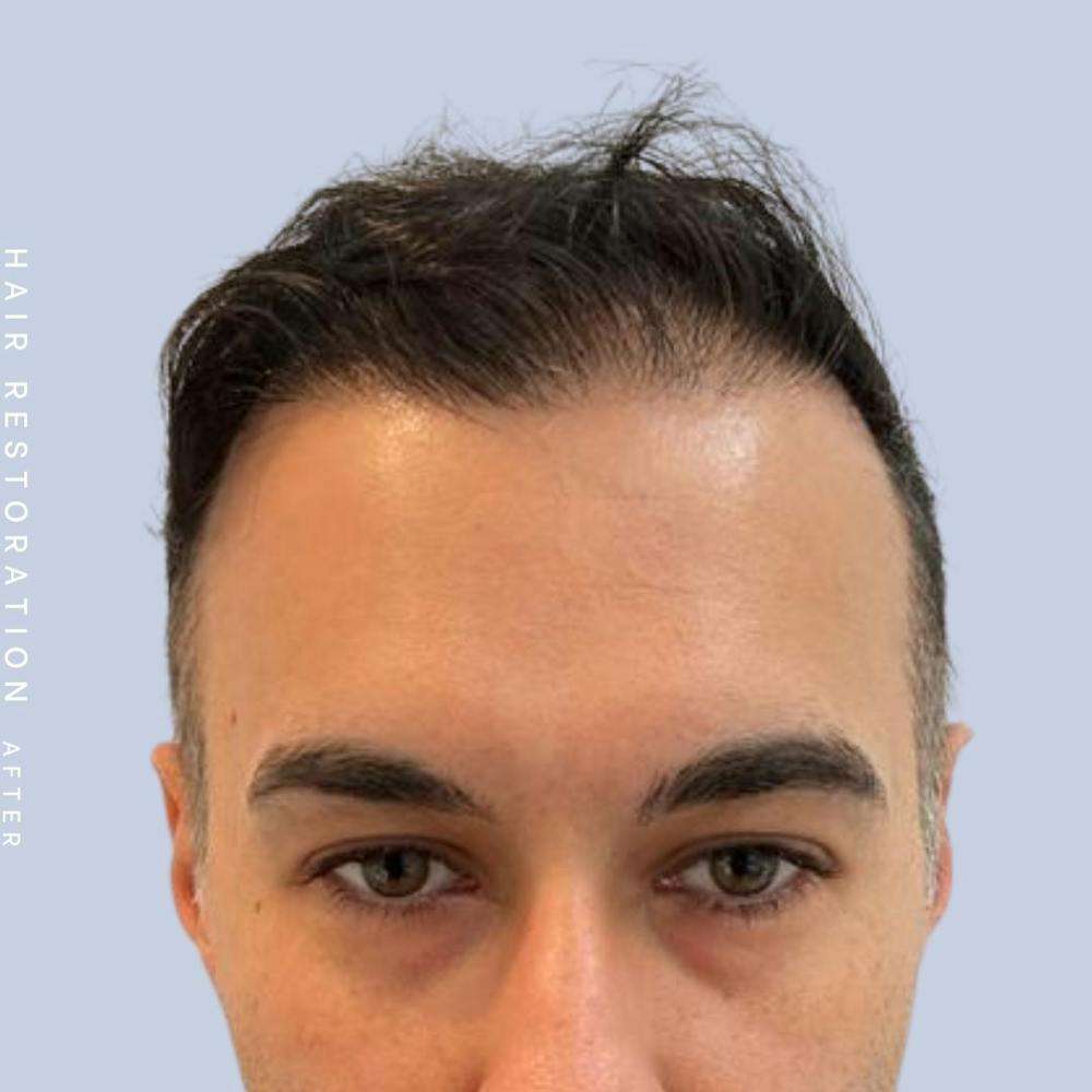 Hair Restoration Before & After Gallery - Patient 142787185 - Image 2