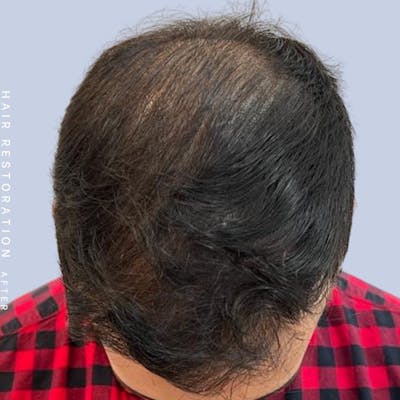 Hair Restoration Before & After Gallery - Patient 142787185 - Image 8