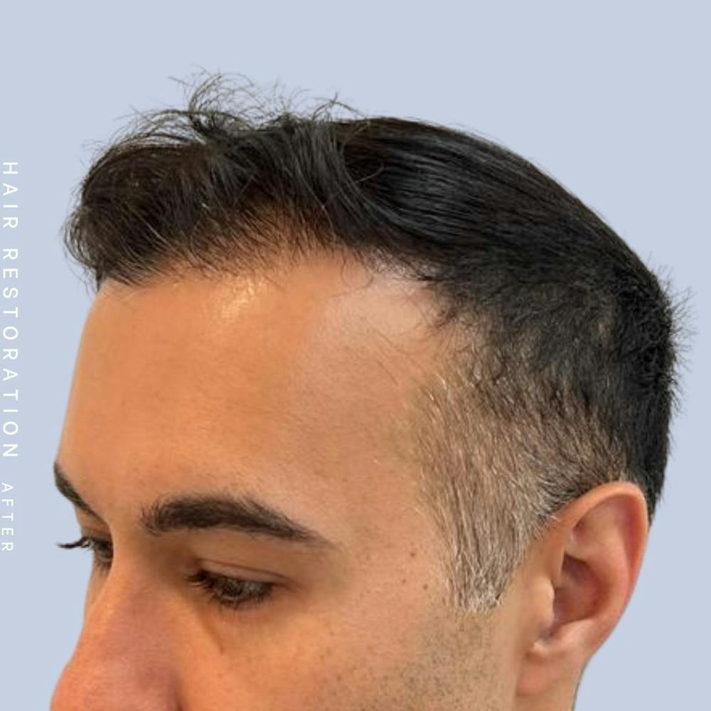 Hair Restoration Before & After Gallery - Patient 142787185 - Image 4