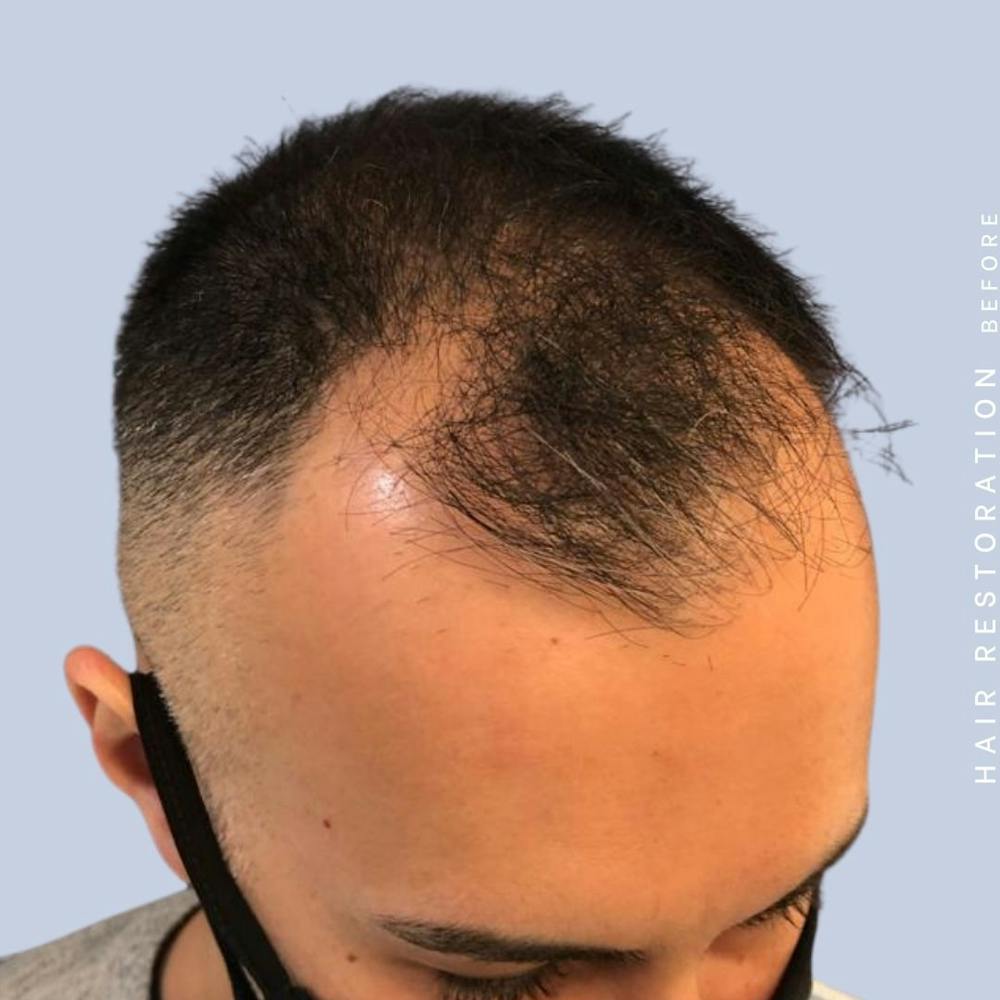 Hair Restoration Before & After Gallery - Patient 142787185 - Image 5
