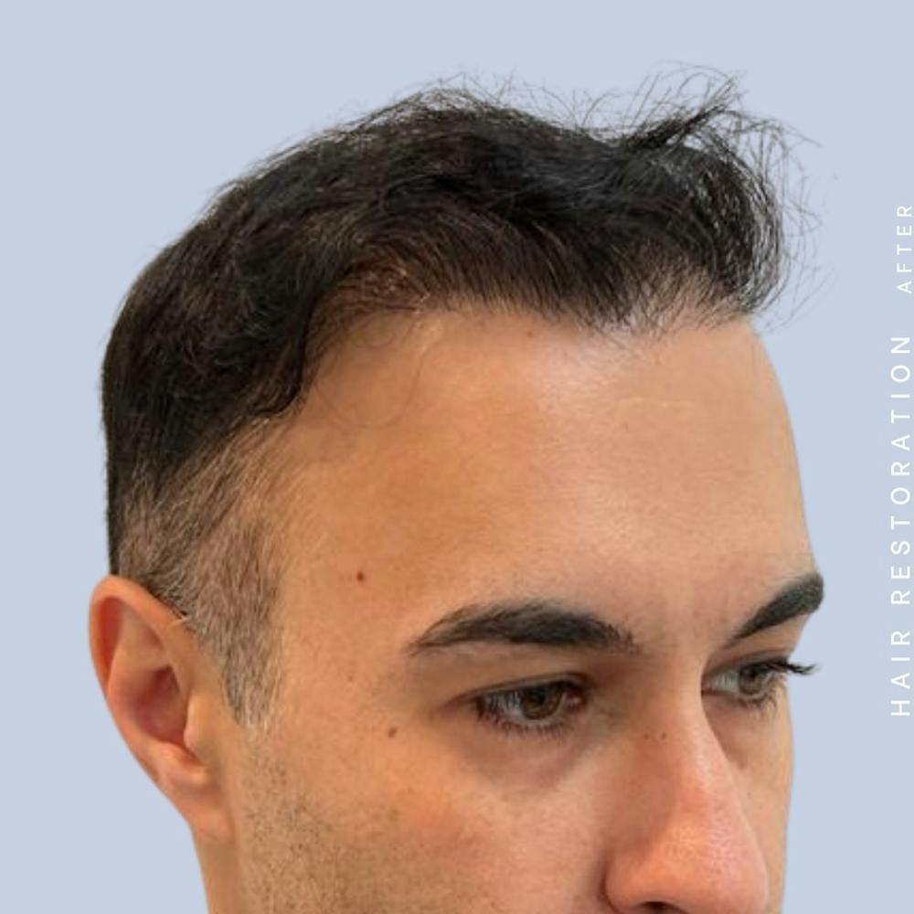 Hair Restoration Before & After Gallery - Patient 142787185 - Image 6