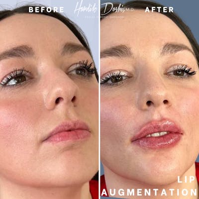 Non-Surgical Lips Before & After Gallery - Patient 146107953 - Image 2