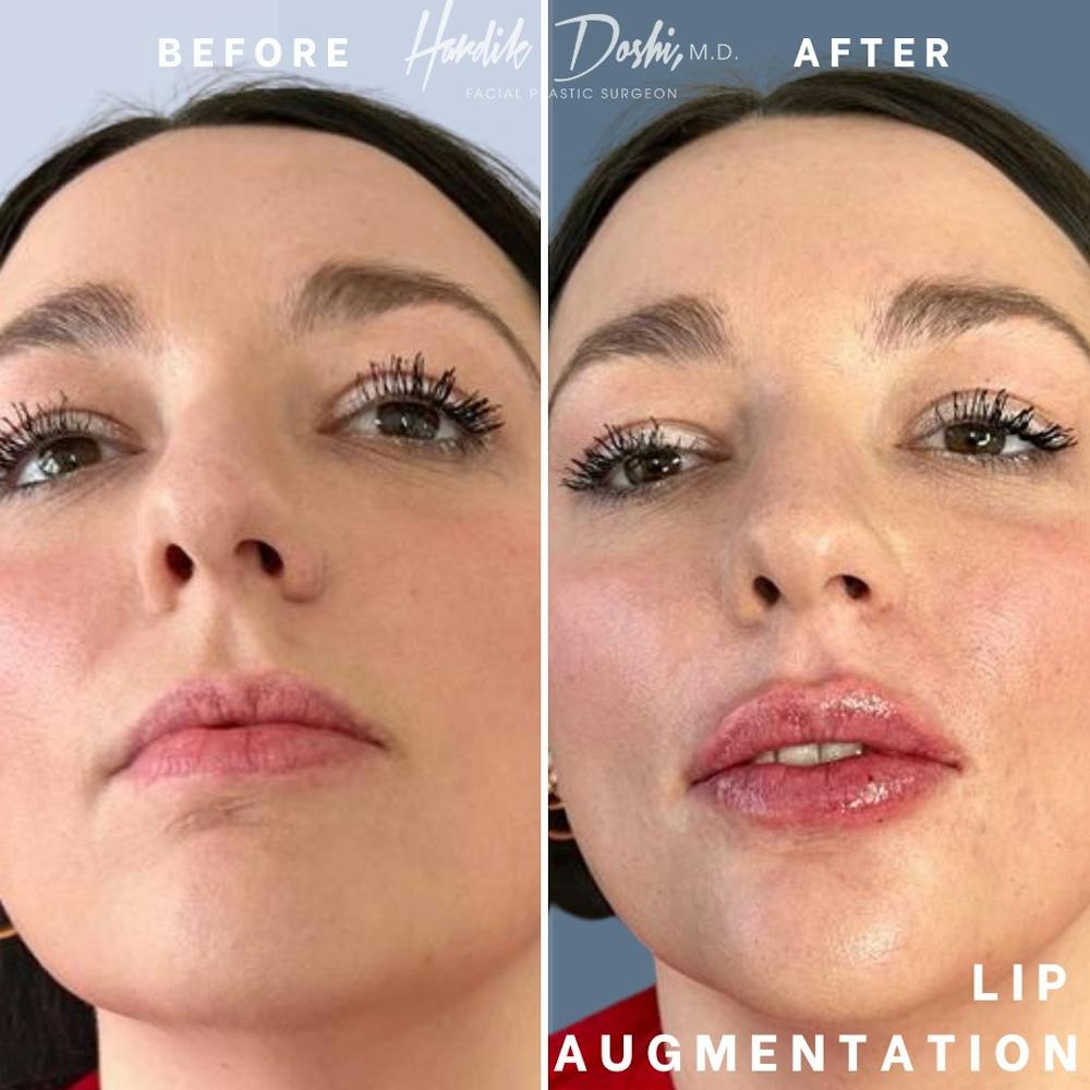 Lips Before & After Gallery - Patient 146107953 - Image 3