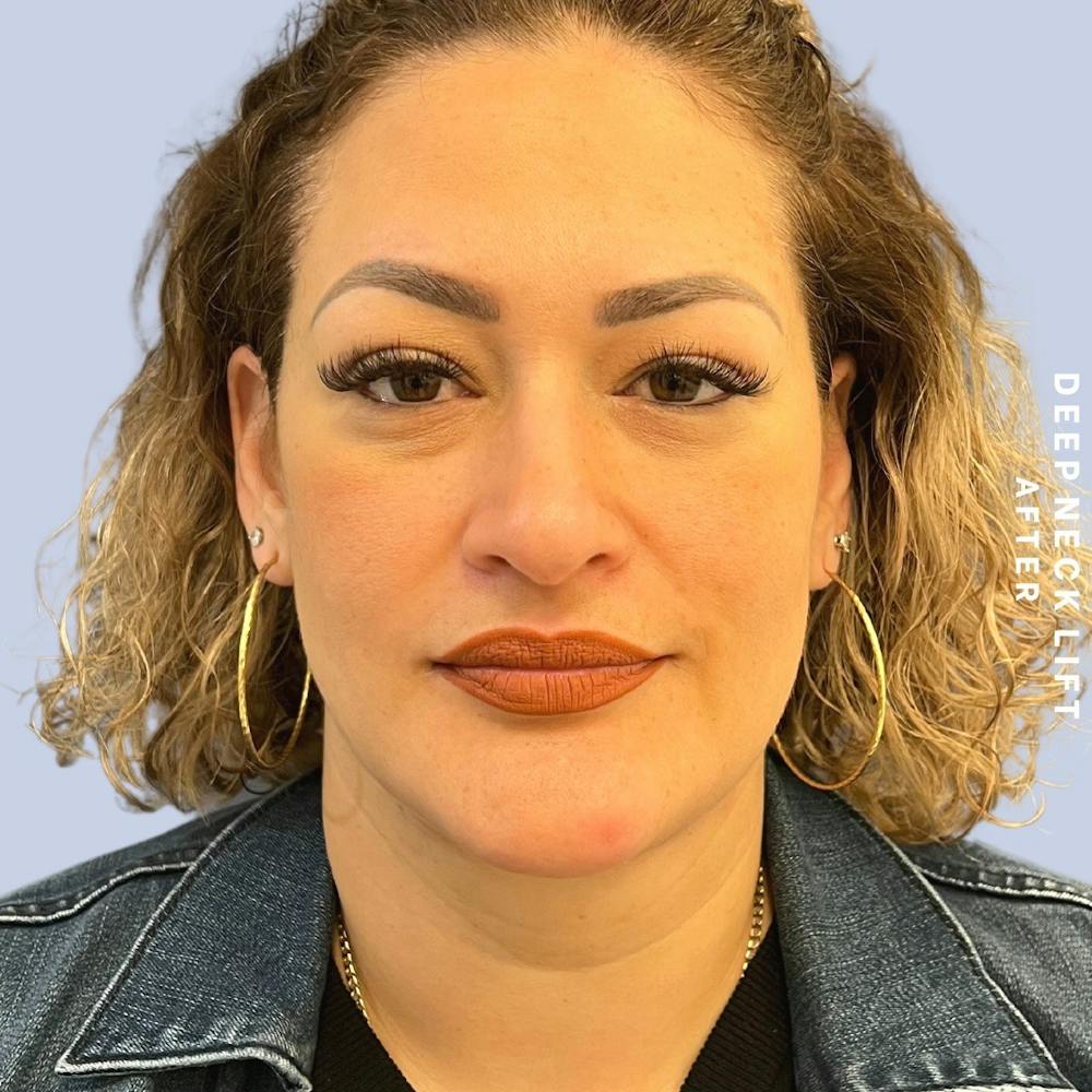 Face & Neck Before & After Gallery - Patient 146249994 - Image 2