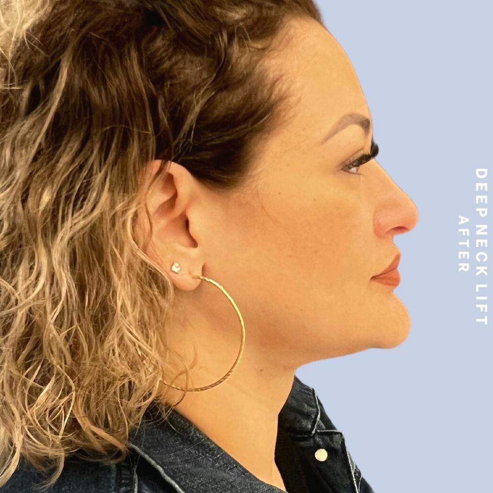 Face & Neck Before & After Gallery - Patient 146249994 - Image 6
