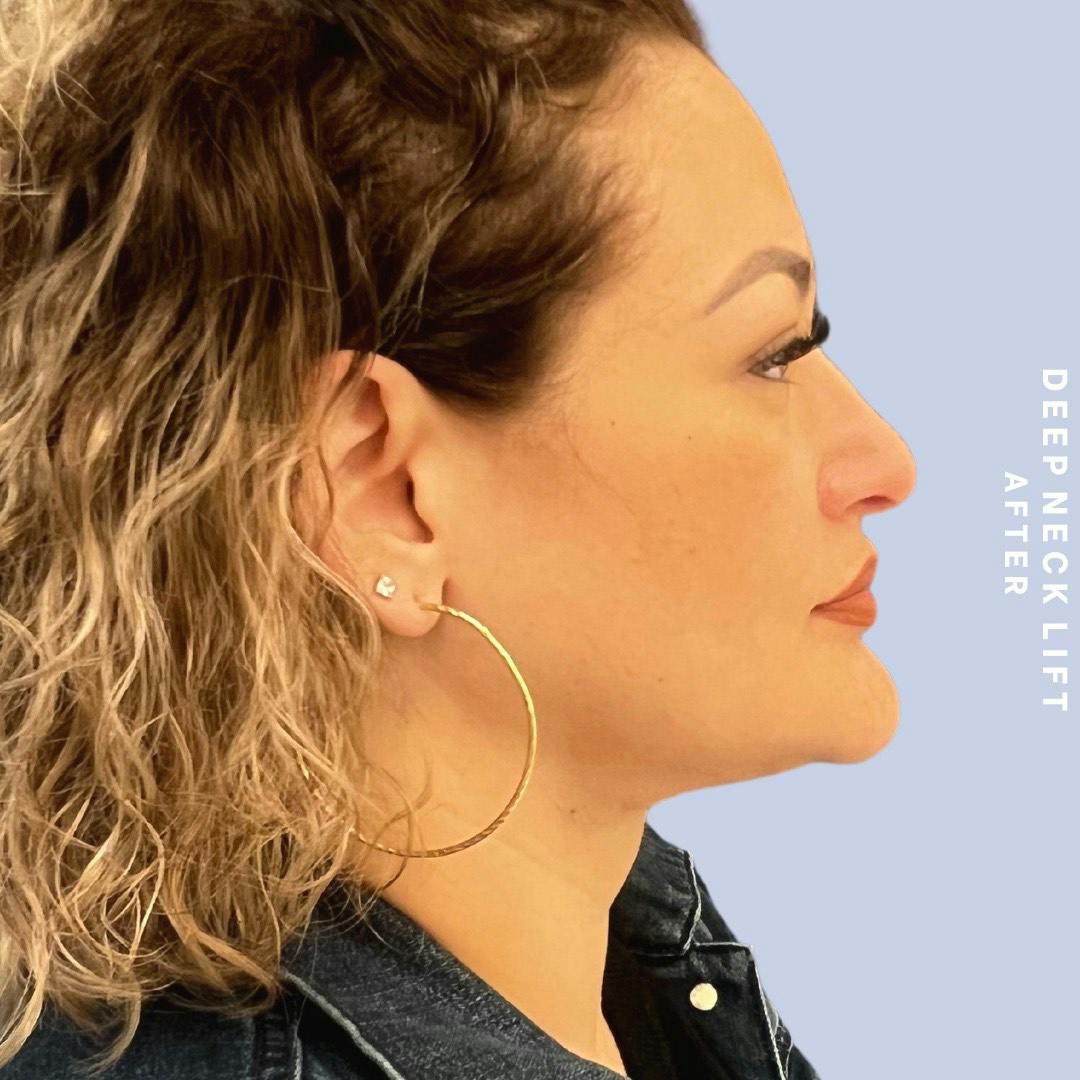 Face & Neck Before & After Gallery - Patient 146249994 - Image 6