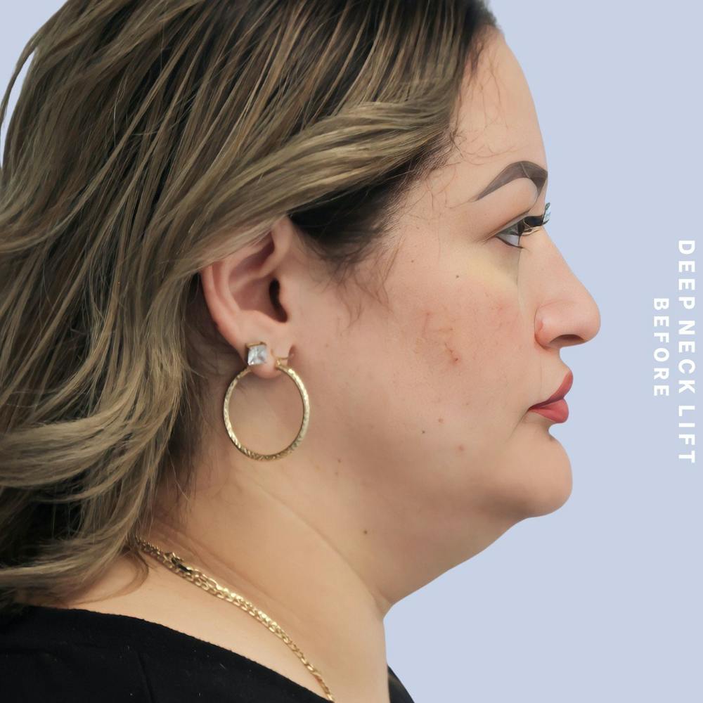 Face & Neck Before & After Gallery - Patient 146249994 - Image 5