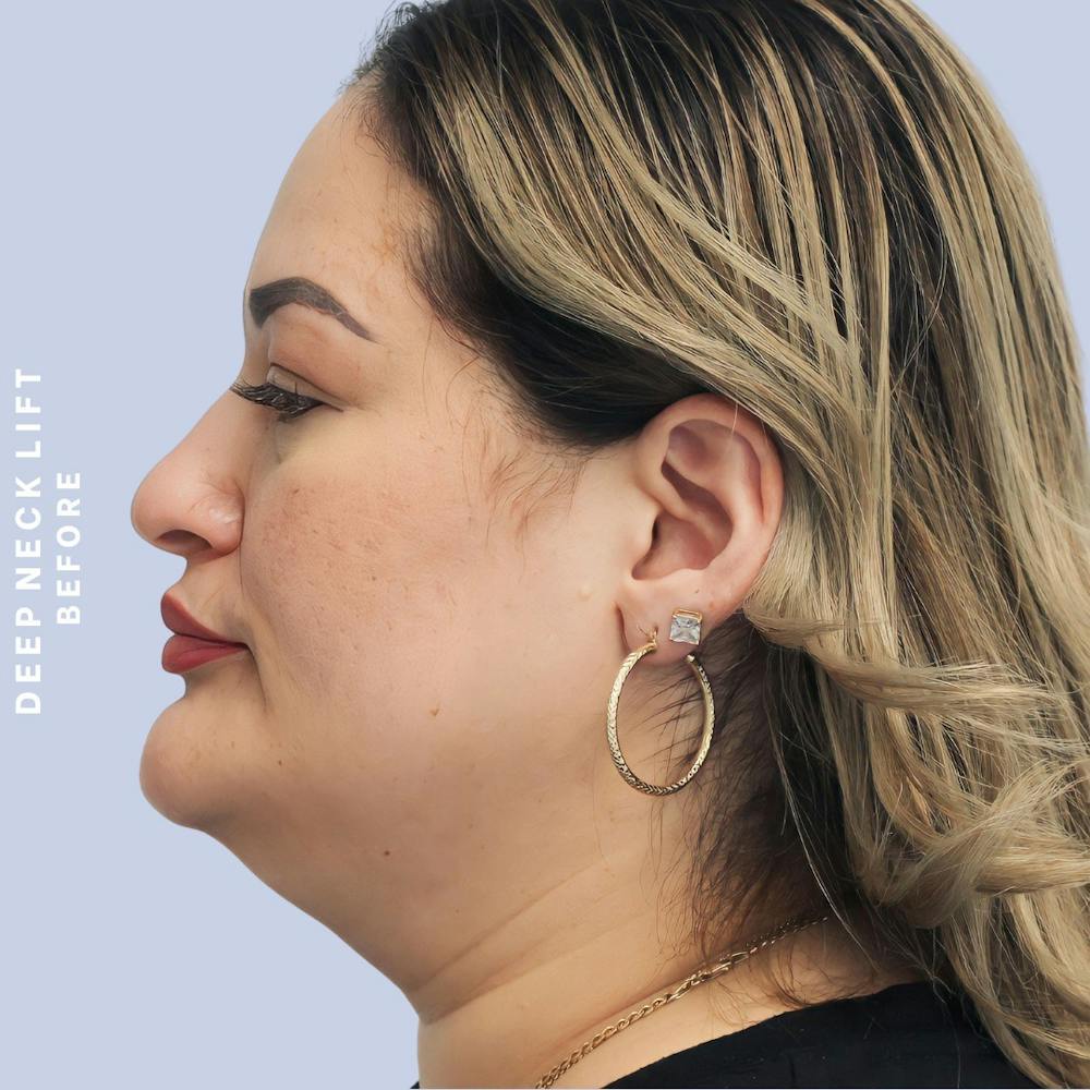 Face & Neck Before & After Gallery - Patient 146249994 - Image 9