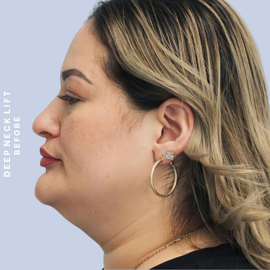 Face & Neck Before & After Gallery - Patient 146249994 - Image 9