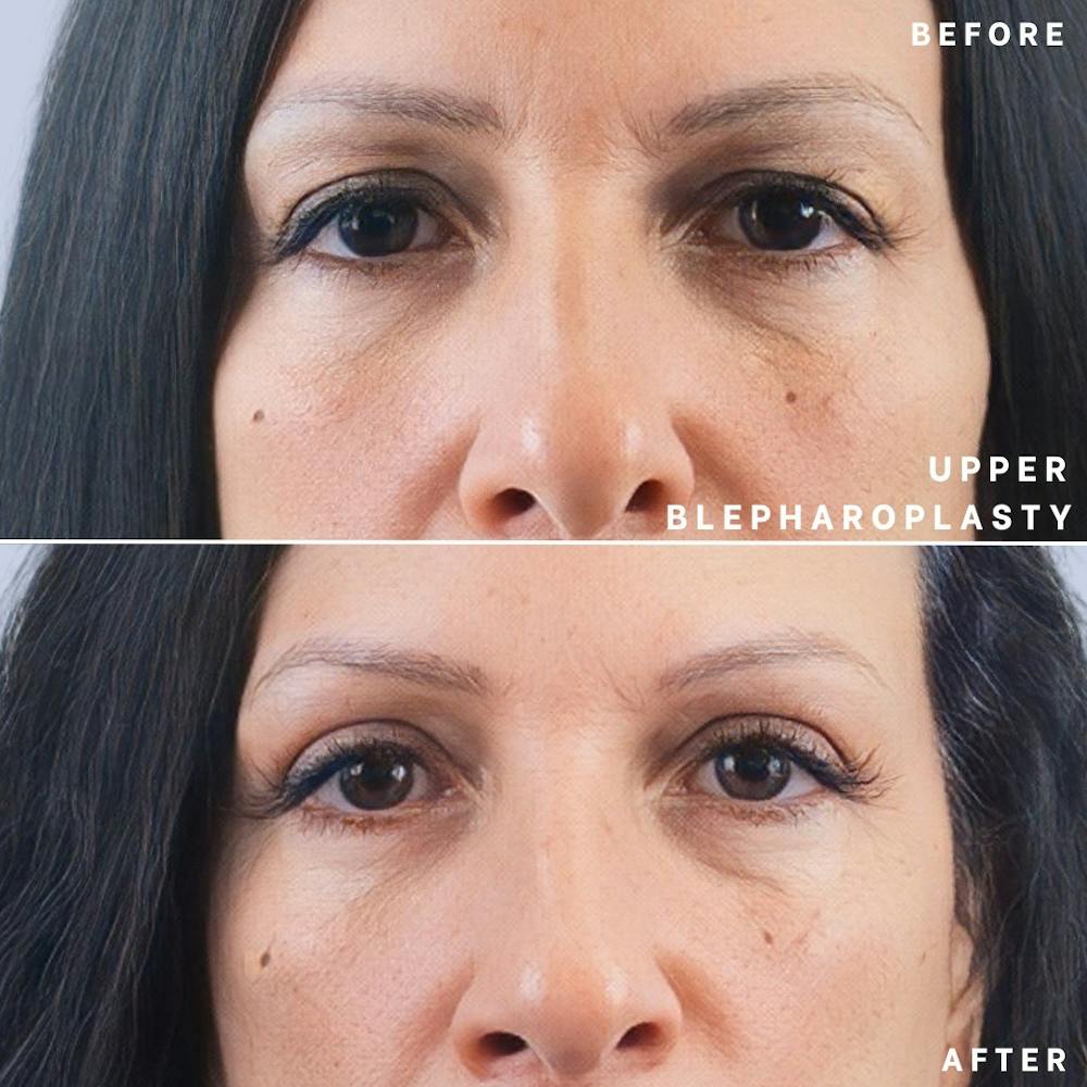 Eyes Before & After Gallery - Patient 146250003 - Image 3
