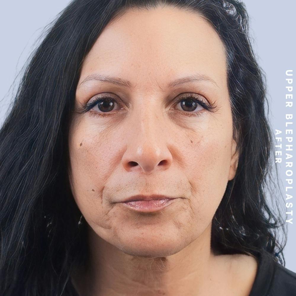Eyes Before & After Gallery - Patient 146250003 - Image 2