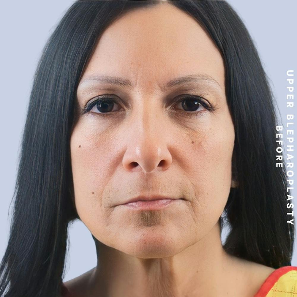 Eyes Before & After Gallery - Patient 146250003 - Image 1
