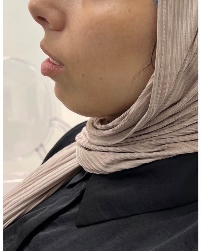 Mouth Before & After Gallery - Patient 146510629 - Image 1