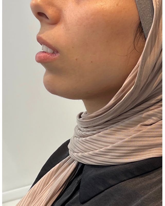 Mouth Before & After Gallery - Patient 146510629 - Image 2