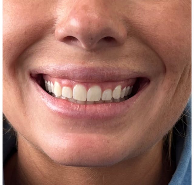 Mouth Before & After Gallery - Patient 146510729 - Image 1