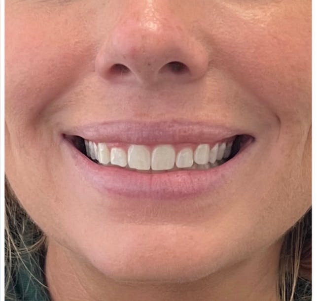 Mouth Before & After Gallery - Patient 146510729 - Image 2