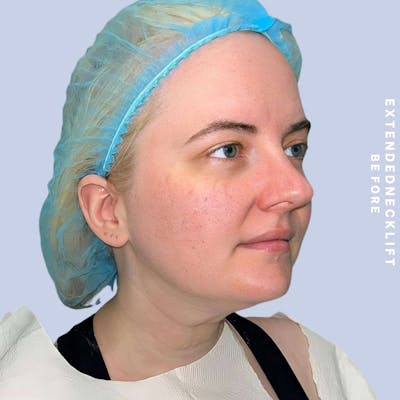 Face & Neck Before & After Gallery - Patient 146644832 - Image 1