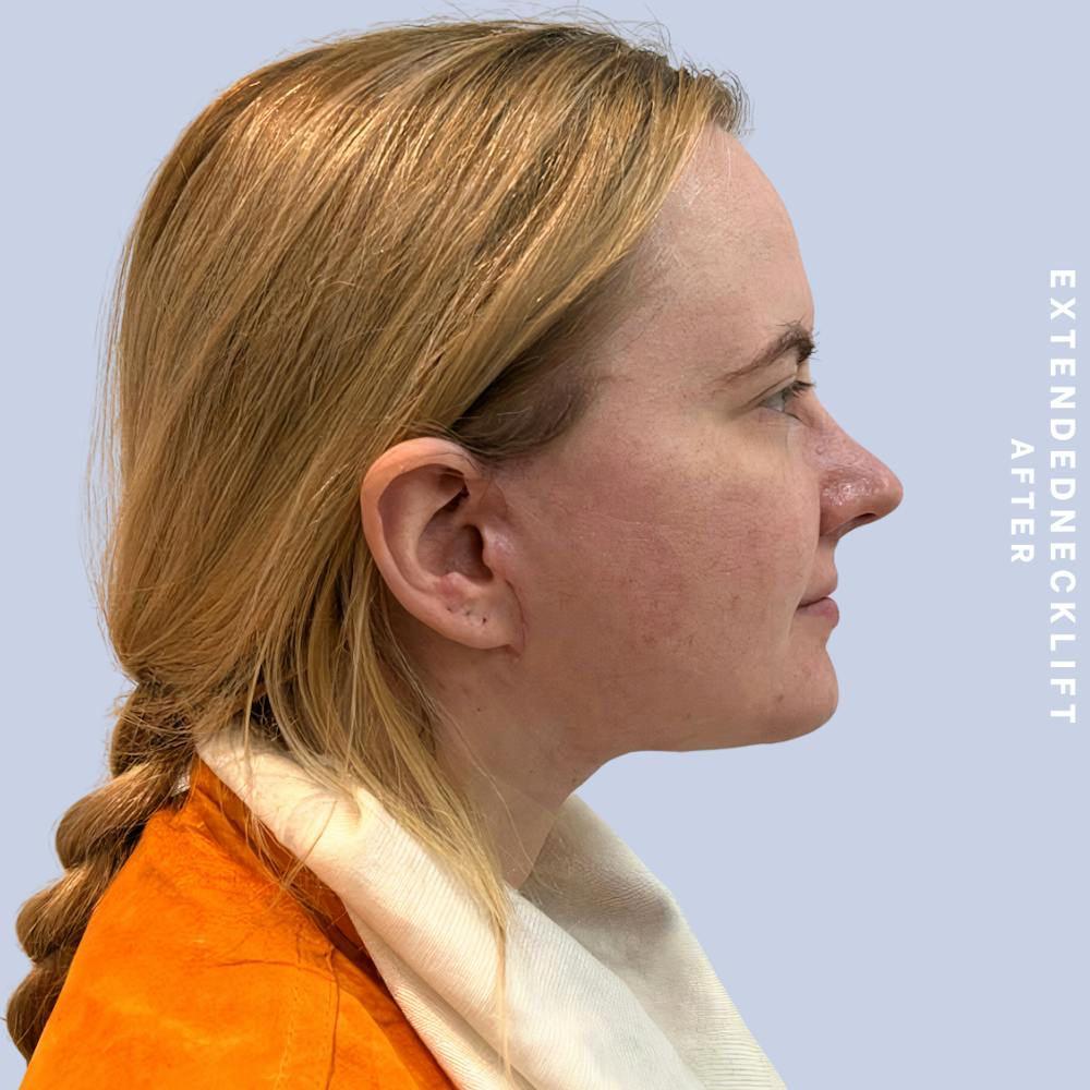 Face & Neck Before & After Gallery - Patient 146644832 - Image 4