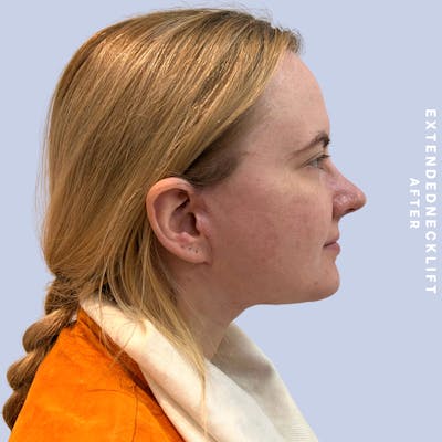 Face & Neck Before & After Gallery - Patient 146644832 - Image 4
