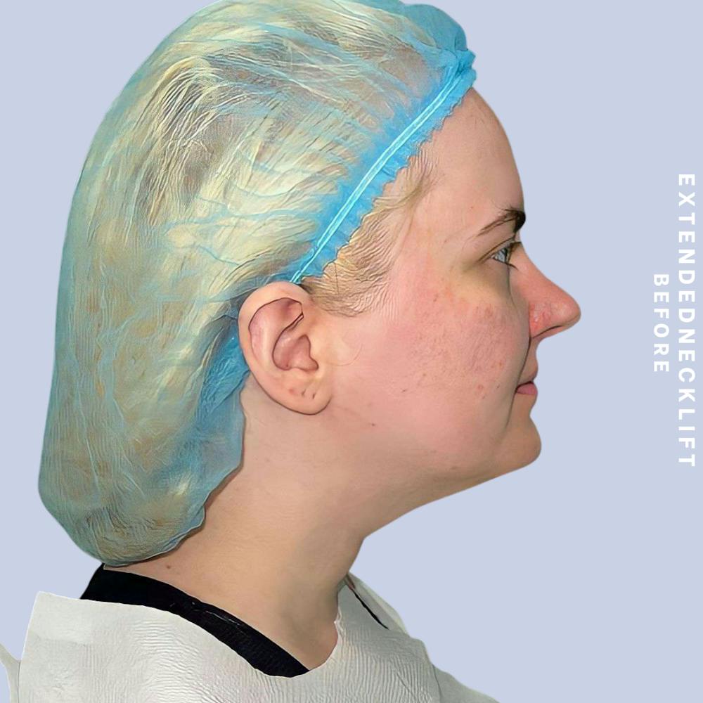 Face & Neck Before & After Gallery - Patient 146644832 - Image 3