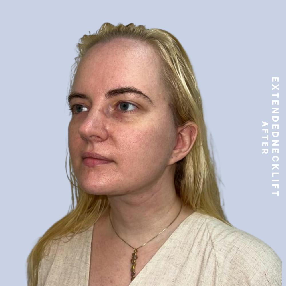 Face & Neck Before & After Gallery - Patient 146644832 - Image 6
