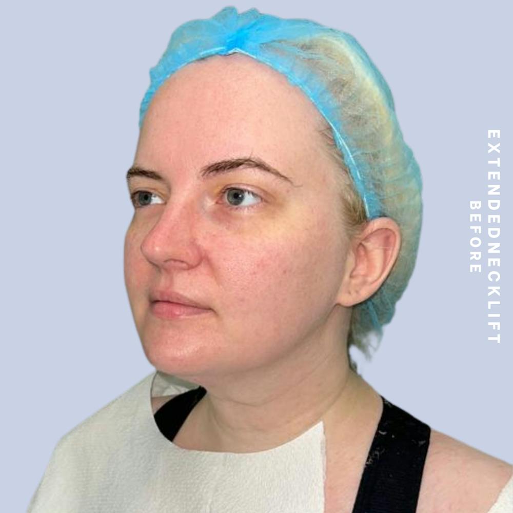 Face & Neck Before & After Gallery - Patient 146644832 - Image 5