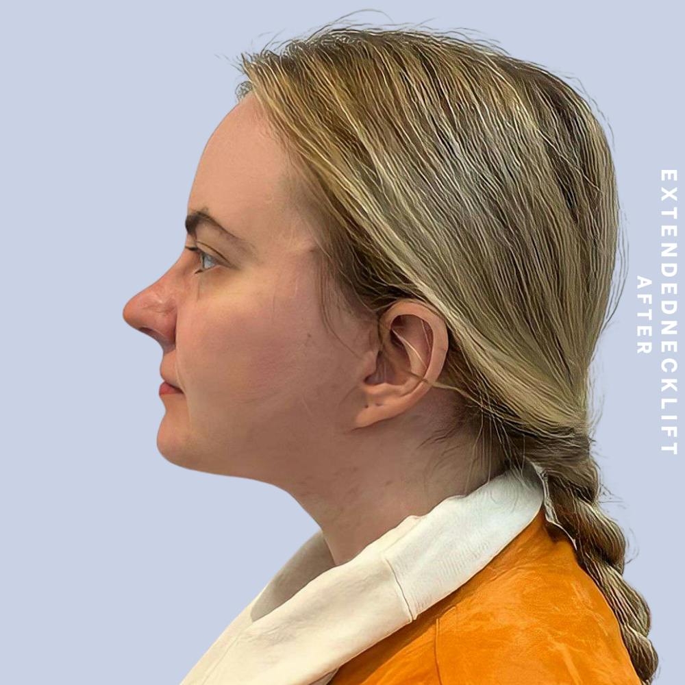 Face & Neck Before & After Gallery - Patient 146644832 - Image 8