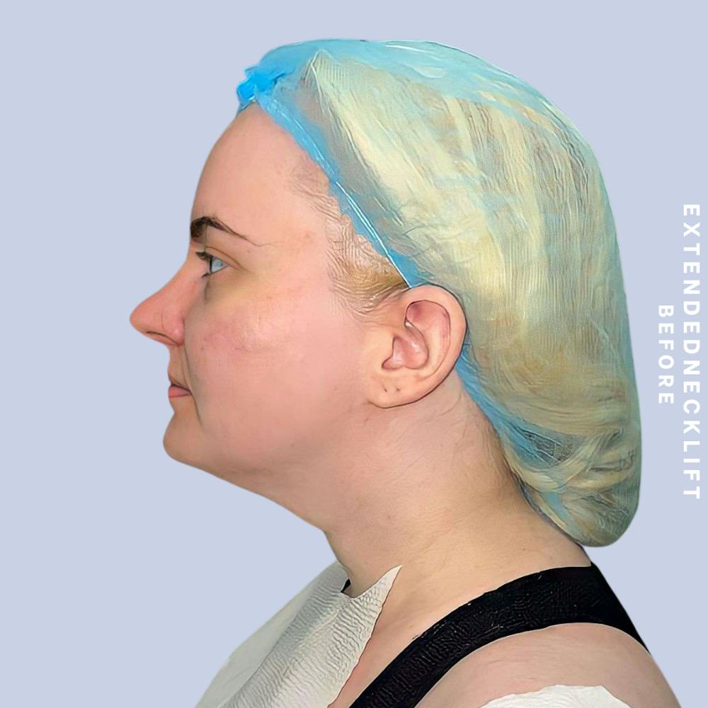 Face & Neck Before & After Gallery - Patient 146644832 - Image 7