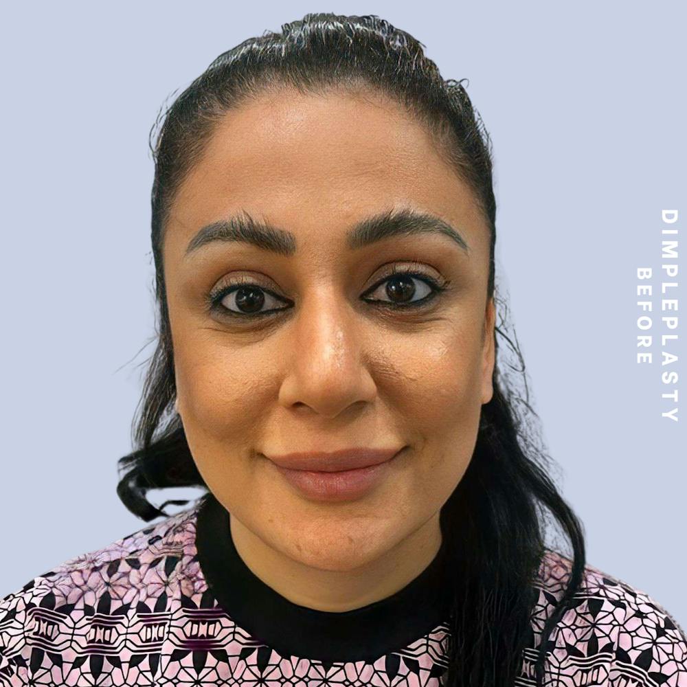 Dimpleplasty Before & After Gallery - Patient 146644838 - Image 1