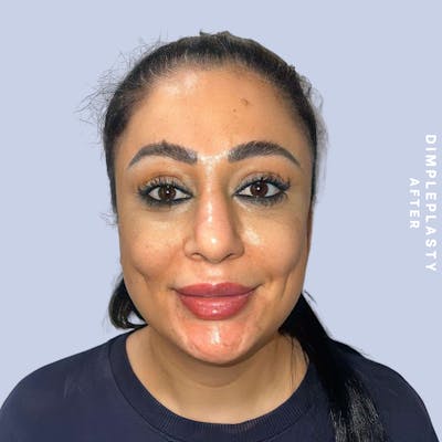 Dimpleplasty Before & After Gallery - Patient 146644838 - Image 2