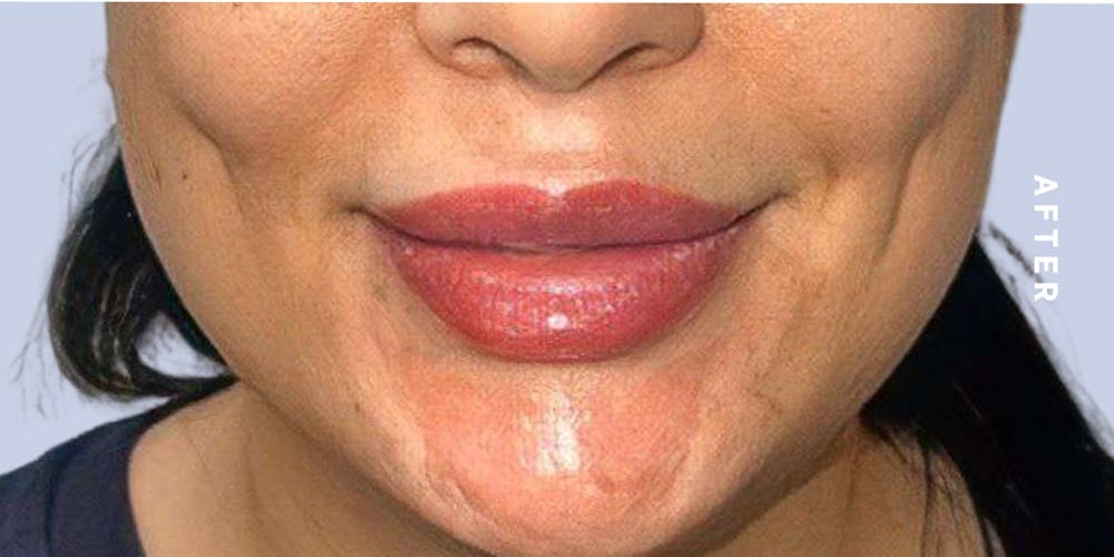 Dimpleplasty Before & After Gallery - Patient 146644838 - Image 4