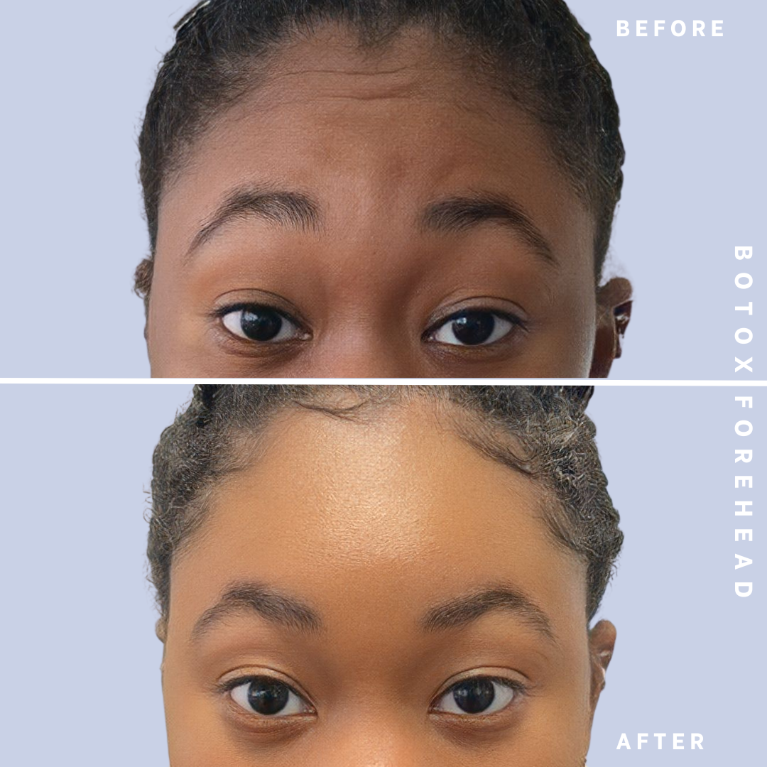 BOTOX results