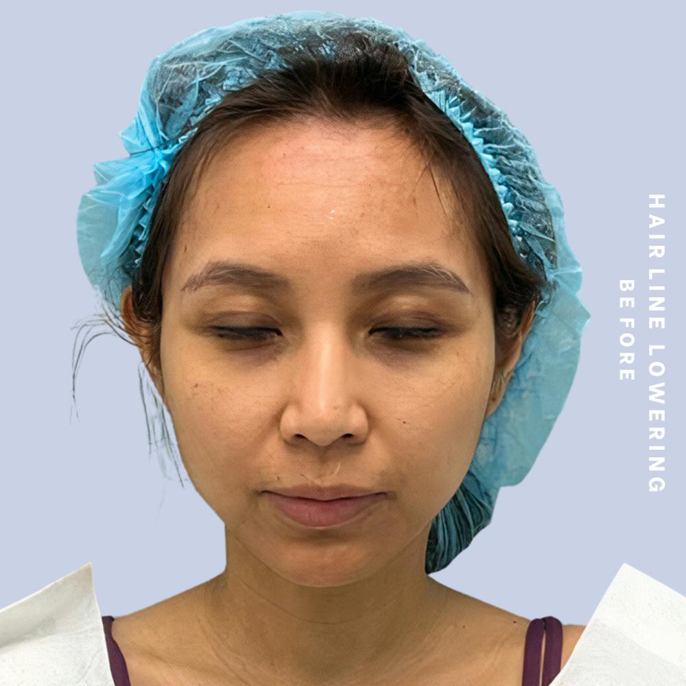 Hair Restoration Before & After Gallery - Patient 146645106 - Image 1