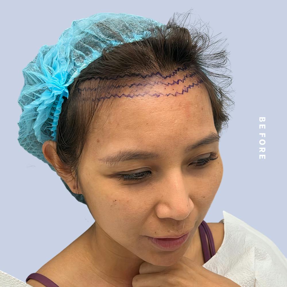 Hair Restoration Before & After Gallery - Patient 146645106 - Image 3