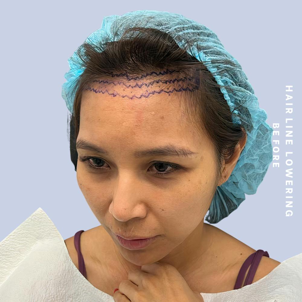 Hair Restoration Before & After Gallery - Patient 146645106 - Image 5
