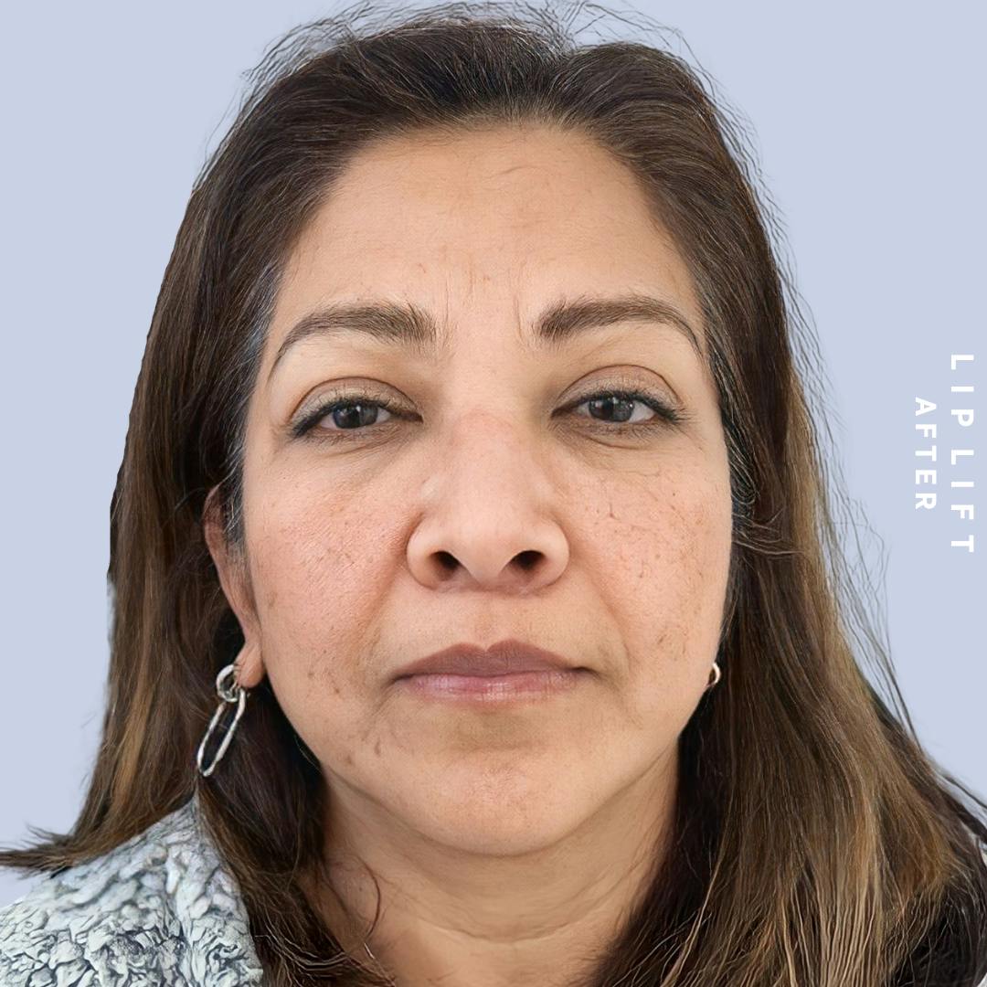 Lips Before & After Gallery - Patient 146698308 - Image 2