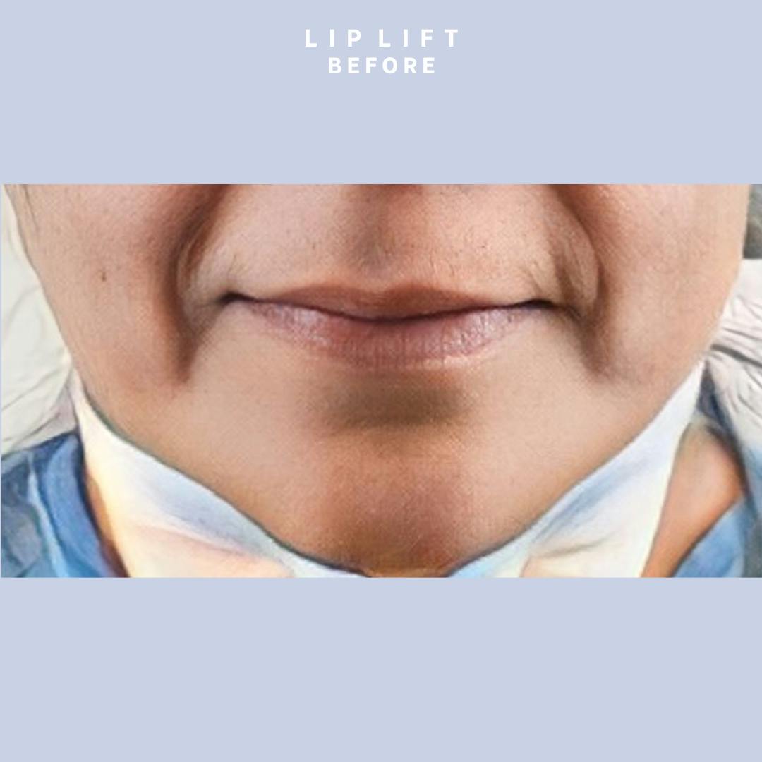 Lips Before & After Gallery - Patient 146698308 - Image 3