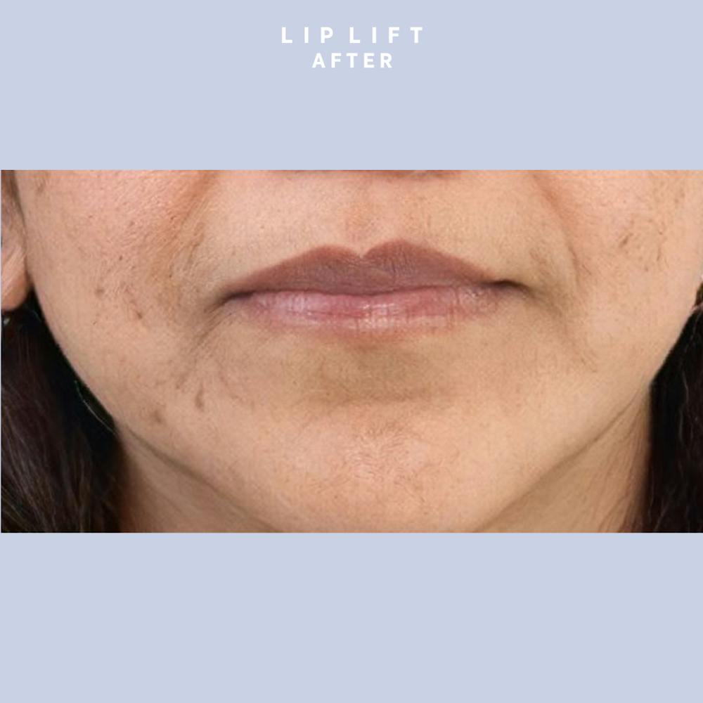 Lips Before & After Gallery - Patient 146698308 - Image 4