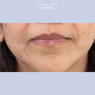 Lips Before & After Gallery - Patient 146698308 - Image 4